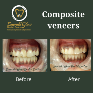 Emerald Before After (1)