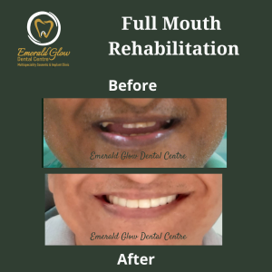 Emerald Before After